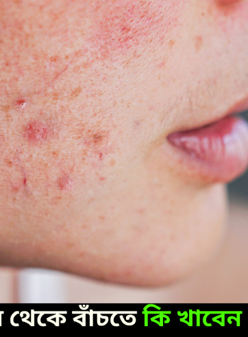 What to Eat and What not to Eat to prevent Acne?